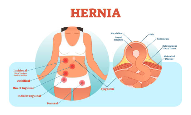 Painless Hernia Surgery